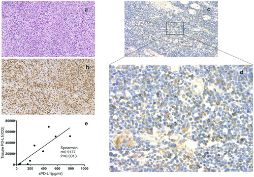 Figure 4. Expression of PD-L1 on lymphoma cells in biopsy tissues from PTCL patients. (a–d) Representative immuohistochemical staining (Case 1). (a) H&E staining. (b) Staining for CD3. (c) Staining for PD-L1 (200×). (d) Staining for PD-L1 (400×). (e) Correlation between concentration of plasma soluble PD-L1 (ng/ml) and PD-L1 expression in tumor tissues (IOD) in patients with PTCL. IOD integrate optical density.