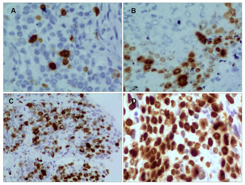 Figure 1 Immunohistochemical staining of Ki-67 expression in advanced lung SCC. (magnification 400×). (A) Score 1: low; (B) score 2: relatively low; (C) score 3: high, and (D) score 4: very high.