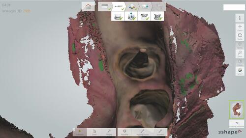 Figure 2 The post-space was prepared 9 mm in depth. It has been scanned by Trios 3shape scanner: 3D software images.