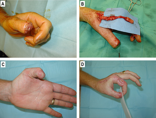 Figure 1 (A) Open wound of the tip of the thumb, 2.5cm x 2.5cm. (B) The kite flap raised over the dorsal index finger. (C) View of the thumb 32 days after surgery. (D) Patient is able to perform pinch and opposition.