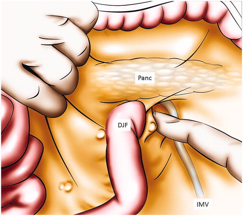 Figure 1. Treitz ligament exploration. This figure illustrates how to explore the peritoneum behind the duodenojejunal flexure, by retracting the first jejunal loop. Panc: pancreas; IMV: inferior mesenteric vein; DJF: duodenojejunal flexure.