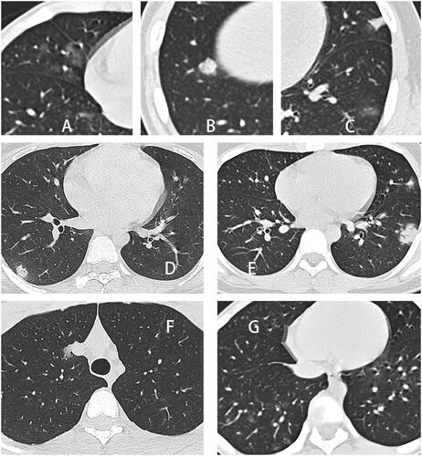 Figure 3. Examples of opacity characteristics and distribution characteristics. (A) Ground-glass opacity in the middle lobe of the right lung. (B) Consolidation of the lower lobe of the right lung. (C) Multiple lesions in the left lung were recorded as GGO and consolidation. (D) A single lesion in the lower lobe of the right lung was recorded as a peripheral distribution. (E) Multiple lesions in the left lung were recorded with a peripheral distribution. (F) A single lesion in the right upper lung was recorded as a central distribution. (G) Multiple lesions in the right lung, mainly located in the peripheral zone of the lower lung, were documented to be distributed along with the bronchial bundles.
