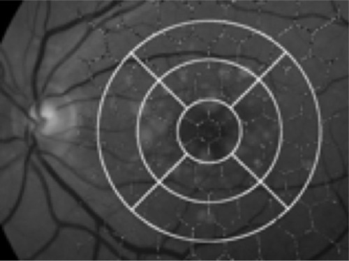 Figure 3 The nine areas of the OCT retinal thickness map and the hexagonal pattern from the mfERG examination, superimposed onto the fundus image of a drusen maculopathy patient for image analysis.