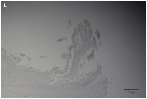 Figure 2 (A) Filament cross, oblique, and lateral sections, from a specimen collected from patient 1 showing round, elliptical/elongated, bean-like, or curved morphology. Note the hollow medulla and surrounding cortex. Cytokeratin (CK) AE1/AE3 staining. 100× magnification. (B) Specimen from patient 1, demonstrating irregular, patchy keratin staining with CK AE1/AE3, longitudinal section. Note most filaments staining positive for keratin (dark brown). 100× magnification. (C) Specimen from patient 1, demonstrating irregular, patchy keratin staining with CK AE1/AE3. Cross, oblique, and longitudinal sections. Note most filaments staining negatively for keratin. 400× magnification. (D) Longitudinal section of filament from patient 1. Note retained nuclei, central medulla, and patchy keratin staining with CK AE1/AE3. 400× magnification. (E) Sectioned filament from a specimen from patient 1, which upon gross microscopic examination demonstrated floral-like or stellate formations. Note retained nuclei within tentacle-like filaments with tapered ends. CK AE1/AE3 staining. 400× magnification. (F) Sectioned callus from patient 1, showing filaments stemming from the stratum basale with evolution inwards towards the dermis. Note filament sections with hollow medulla alongside the stratum basale. CK AE1/AE3 staining. 100× magnification. (G) Gömöri trichrome collagen-positive section of activated fibroblasts with filamentous inclusions from patient 2. Collagen stains green, keratin stains red. Growth of filaments was upwards toward the external surface. 400× magnification. (H) Ruptured keratin projection from both external and internal surfaces from a specimen collected from patient 2, with areas of fibroblast proliferation stained green. Gömöri trichrome stain. 100× magnification. (I) Section from patient 2 stained with Gömöri trichrome, demonstrating both keratin (red) and collagen (green) filament cross-sections, with most filaments associated with the external callus surface. 100× magnification. (J) Gömöri trichrome stain of specimen from patient 2, demonstrating filaments in longitudinal, oblique, and cross-sections close to and within collagen-positive fibroblast collections (green). Note presence of filament cross-sections staining positively for keratin (red). 400× magnification. (K) Bovine digital dermatitis (BDD) filament, longitudinal section, showing positive CK AE1/AE3 staining. 100× magnification. (L) BDD filament, longitudinal section, showing negative CK AE5/AE6 staining. 100× magnification.