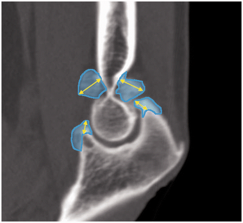 Figure 3. Measurement of bone morphology. A CT image of a sagittal plane through the bottoms of the coronoid and olecranon fossae of the distal humerus. The maximal values of the heights of the bone protruding from the contour surface, which is assumed to be the normal anatomical morphology, are shown. The heights of the bones (yellow lines with arrows) and their areas (in blue) are measured.