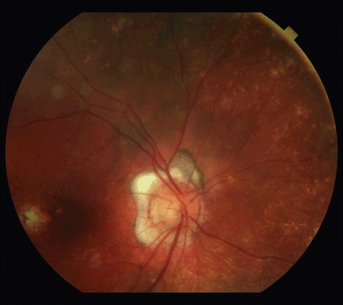 FIGURE 1  Fundus photograph showing sunset glow fundi.