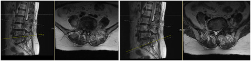 Figure 2 T1WI, epidural abscess in the spinal canal of L3–5.
