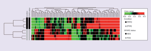 Figure 1.  Heat map depicting the relative fold change in expression of differentially expressed genes in the comparison of TNBC/SPARC+ vs TNBC/SPARC-.The hierarchical cluster shows the fold change inexpression of the 50 TOP upregulated genes and 50 TOP downregulated genes, using the cut off foldchange ≥ 3. Columns in heat map correspond to the samples categorized as TNBC with SPARC positive expression and good prognosis (in grey) and TNBC with SPARC negative expression and poor prognosis (in black). Transcript enrichment is encoded in the heat map in green when showing downregulation; or red when showing upregulation in the comparison of TNBC/SPARC+ vs TNBC/SPARC.TNBC: Triple negative breast cancer; TOP: Gene expression profiling of TNBC with differences in SPARC expression.
