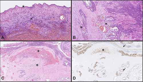Figure 3 Morphology of the tumor in the cystoprostatectomy specimen. (A) Tumor cells in luminal portions of the bladder are growing in small irregular nests (arrow) and as single cells. No urothelial carcinoma in situ was detected (asterisk) (HE stain). (B) Tumor cells in deeper portions of bladder are growing in solid nests and cords with presence of eosinophilic basement membrane-like material and focal microcystic architectural pattern, indicative of basal cell carcinoma (asterisk) (HE stain). (C) Periurethral portion of the prostate infiltrated with basal cell carcinoma growing in cords and as single cells with intratumoral hemorrhage (asterisk) (HE stain). (D) GATA3 stain of periurethral portion of prostate is showing positive tumor cells (asterisk) as well as basal cells of normal prostate glands and urothelium of prostatic urethra (arrows).