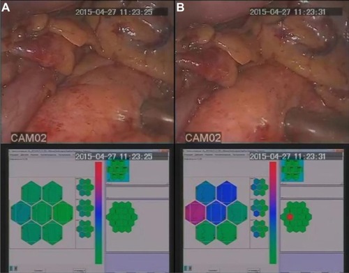 Figure 3 Tactile identification and localization of a visually undetectable lesion during a pancreas resection: simultaneously registered intraoperative video frames and tactile frames. (A) A press on a homogeneous area. (B) A press on the lesion boundary.