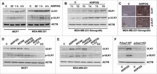 Figure 5. ADIPOQ/adiponectin increases ULK1 expression via AMPK in breast cancer cells. (A) MCF7 and MDA-MB-231 cells were treated with 5 µg/ml ADIPOQ/adiponectin for various time intervals as indicated and total cell lysates were immunoblotted for ULK1 and phospho-ULK1 (p-ULK1) expression. ACTB is used as a loading control. (B) Total protein lysates from tumors from control-adenoviral (Ad-Luc) (denoted as C) and ADIPOQ/adiponectin-adenoviral (Ad-ADIPOQ)-treated mice were examined for the expression of ULK1 and p-ULK1. ACTB was used as a loading control. (C) Tumors from vehicle (V) and ADIPOQ/adiponectin-treated mice were subjected to immunohistochemical analysis using ULK1 and p-ULK1 antibodies. Scale bar: 100 µm. (D, E) MCF7 and MDA-MB-231 cells were treated with ADIPOQ/adiponectin (5 µg/ml), compound C and AICAR alone and in combination as indicated, and total cell lysates were immunoblotted for ULK1 and p-ULK1 expression. ACTB was used as a loading control. (F) Prkaa1 wild-type (Prkaa1-WT) and prkaa1 knockout (prkaa1-KO) MEFs were treated with 5 µg/ml ADIPOQ/adiponectin and total cell lysates were immunoblotted for ULK1 and p-ULK1 expression. ACTB was used as control.