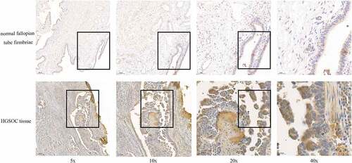 Figure 2. The CCNE1 expression on normal fallopian tube fimbriae (n = 10) and HGSOC tissue (n = 4). The IHC staining of CCNE1 (brown) in fallopian tube fimbriae and HGSOC tissue. Scale bar: 20 μm (40x).