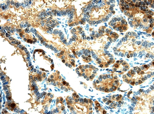 Figure 2.  Galectin-3 staining of papillary microcarcinoma (×200)