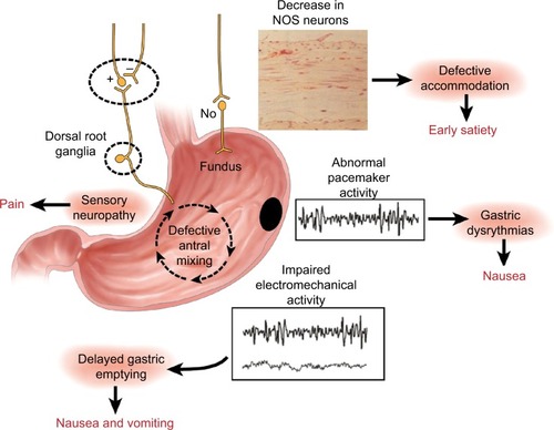 Figure 1 Summary of the neural, myoelectrical, muscular, and cellular aspects of the pathophysiology of gastroparesis.