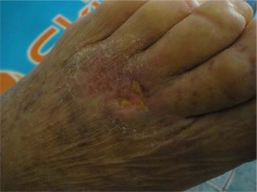 Figure 1 Ulceration on the dorsal aspect of the left foot: inflammatory rim around the ulceration, desquamation, and diffuse erythema.