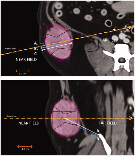 Figure 1. (Top image) Overview of STS evaluation and critical structure measurements in the near field. Each STS was evaluated in three planes. This image illustrates an axial projection (CT image) of an STS tumour present in the right flank. The target cell (4 mm) is positioned centrally within the constructed PTV, and the HIFU beam is aligned to the target cell. Measurements included (A) the closest distance from the skin to any tumour margin, with (B) the distance from the skin to the centre of the tumour in the near-field, and (C) the distance from the skin to the deepest tumour margin in the far field, both acquired along the HIFU beam path. (Bottom image) Overview of STS evaluation and critical structure measurements in the far field. Dorsal projection of the same tumour in the right flank. The target cell is unchanged in location and remains the same point of reference for measurements along the beam axis. Critical structure measurements for bone were acquired from (A) the centre of the tumour to nearest bone structure in the far field and (B) the tumour margin to nearest bone structure in the far field.