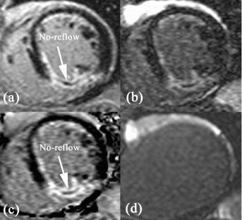 Figure 2. Images from the conventional IR-TFL (a), the magnitude reconstructed IR-trueFISP (with TI=300 ms) (b)-note the reduced contrast between infarct and normal myocardium, as well as the signal variability, the corresponding PSRecon IR-trueFISP (c) obtained using the coil sensitivity map (d) collected from the low flip angle trueFISP acquisition.