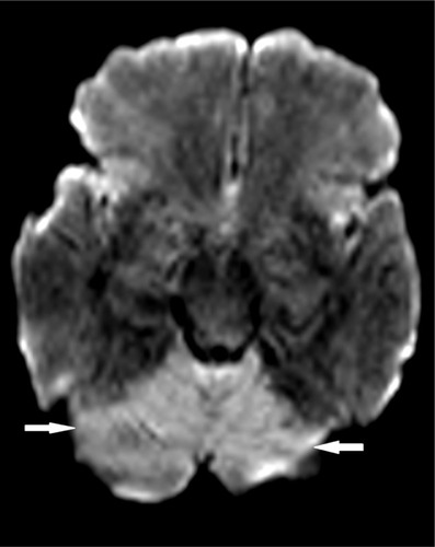 Figure 3 Axial diffusion-weighted image showing restricted diffusion involving the entire cerebellum bilaterally (arrows).