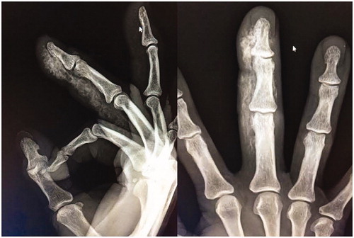 Figure 2. Radiograph demonstrating foreign material in the volar aspect of the right long finger, extending far beyond the injection site, lateral (left) and AP (right) views.