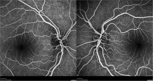 Figure 4 FA of patient 2 revealed vascular network papillary and peripapillary vascular microdilations, without diffusion in late stages.