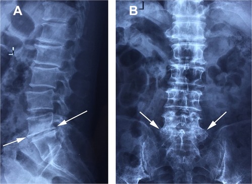 Figure 1 Radiographs showing advanced lumbar spinal degeneration, with reduced height of the L5-S1intervertebral space (A) and extensive osteophytes (A, B arrows).