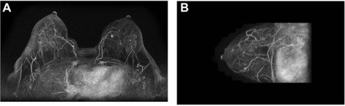 Figure 1 Maximum intensity projection post-processing three-dimensional angiographic reconstruction images on axial (A) and sagittal (B) view.