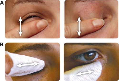 Figure 4 (A) Eyelid cleaning procedure: eyelid massage to express waxy meibomian secretion. (B) Eyelid cleaning procedure: cleaning of eyelid margin.