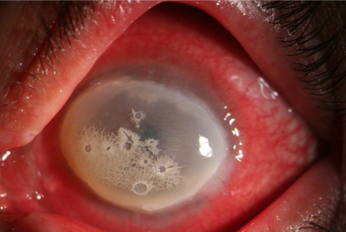 Figure 2 Corneal Ulceration in Anesthetic Keratopathy Resembling Mooren’s Ulcer.