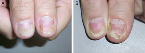 Figure 1 The thumbs of the patient mainly show nail bed involvement with subungual hyperkeratosis, salmon spot, and onycholysis.