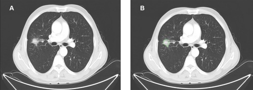 Figure 1 Representative computed tomography image of a 60-year-old man with lung adenocarcinoma. (A) A tumor in the left lobe was chosen to delineate region of interest. (B) One radiologist delineated the region of interest, which is shown in green outline.