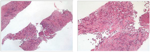 Figure 2. Histological pictures of liver biopsy.