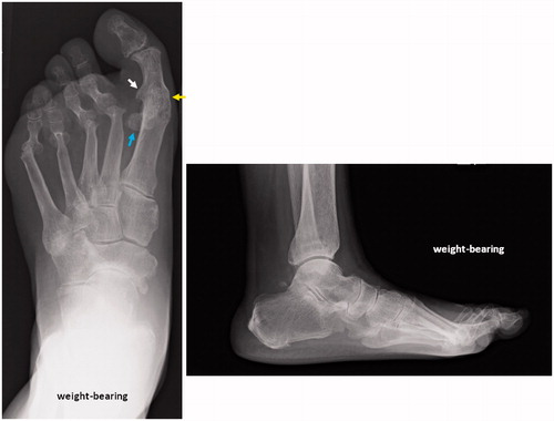Figure 1. Preoperative X-ray of the affected foot. The MTP-1 joint is fused in malposition (yellow arrow). The X-ray shows the internal rotation of the proximal phalanx (white arrow), and the sesamoid bone is laterally shifted (blue arrow) (Hardy grade 4).