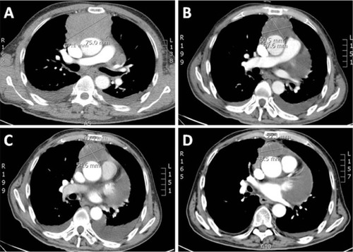 Figure 1 (A) Baseline computed tomography (CT) scan of the chest with contrast on initial evaluation. (B) Follow-up CT scan at 1 month after radiotherapy. (C) A CT scan taken 2 months after chemotherapy indicating stable disease. (D) A CT scan taken 60 days later showing dramatic improvement in the mediastinal tumor after treatment with oral sorafenib 400 mg twice per day.