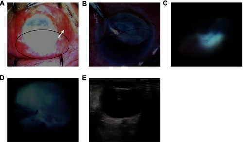 Figure 1 Clinical features of mycobacterium fortuitum endophthalmitis. (A) Biomicroscopic examination identified conjunctival congestion (represented by the white arrow) and a distorted pupil obscured by hypopyon (the pupillary margin hidden in the circle). (B) Biomicroscopic examination identified a severe fibrinous reaction (the fibrinous tissues in the circle) and hypopyon in front of the intraocular lens (represented by the black arrow). (C and D) The vitreous and fundus have a yellow and white purulent exudate. (E) A B-scan ocular ultrasound identified vitreous opacification.