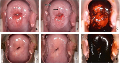 Figure 2. Colposcopy images of CIN2 before FU treatment (A/B/C) and at 6 months after FU treatment (D/E/F). (A) the cervix was exposed and the squamocolumnar junction was fully visible. (B) With a 5% acetic acid test, thin acetowhite soon appeared in the transformation area, and the edge thickened, especially in the direction of 12 o‘clock, as indicated by the arrow. (C) With a 1% iodine test, the transformation area and local edges were unstained, especially at the point indicated by the arrow. (D) The cervix was completely covered with mature squamous epithelium. (E) With a 5% acetic acid test, an obvious abnormality was not observed. (F) With a 1% iodine test, the entire cervical surface was stained.