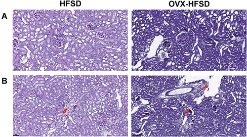 Figure 3 Mesangial expansion (A) and mononuclear cell infiltration (B) of PAS stained kidneys of high fat style diet (HFSD)-fed rats, with and without ovariectomy (OVX) (n = at least 4 per group). Red arrow indicates the mononuclear cell infiltration. Magnification: 400×.