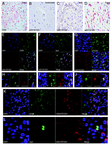 Figure 1. Mutant IDH1R132H detected in glioma-infiltrating microglia/macrophages (GIMs). (A) GIMs as labeled by CD68 significantly contribute to the cellular components of a glioma. (B) Mutant IDH1R132H is not detected in a control brain. (C) Mutant IDH1R132H is not detected in glial cells around an AVM. (D) Mutant IDH1R132H is detected in a glioma. (E) GIMs double positive for CD68 and mutant IDH1R132H are shown in overview. (F) GIMs double positive for Iba1 and mutant IDH1R132H are shown in overview. (G) GIMs double positive for CX3CR1 and mutant IDH1R132H are shown in overview. (H) Detail of GIMs double positive for CD68 and mutant IDH1R132H. (I) Detail of GIMs double positive for Iba1 and mutant IDH1R132H. (J) Detail of GIMs double positive for CX3CR1 and mutant IDH1R132H. (K) Glial tumor cells co-express GFAP and mutant IDH1R132H. (I) Mutant IDH1R132H positive cells do not co-express Ki67.