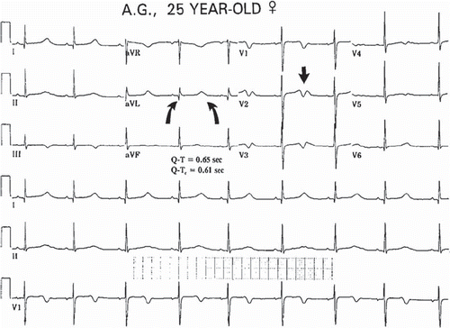 Figure 6. The ECG in long QT syndrome. QTc of 610 ms, with a T wave morphology suggesting type 2 long QT, is recorded from a 25-year-old female with a history of recurrent syncope and torsade de pointes. Paper speed 25 mm/s, gain 10 mm/mV.