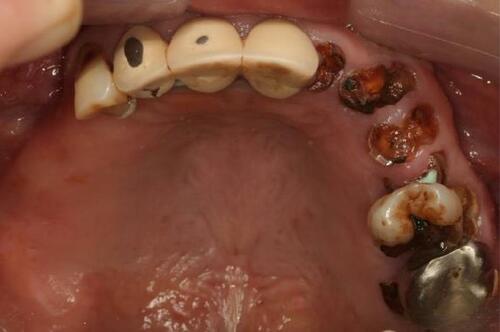 Figure 3 Upper occlusal view (flipped mirror image).