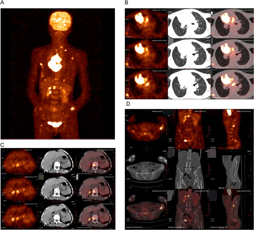 Figure 1 Positron emission tomography computed tomography (PET-CT) scan of baseline. (A) PET-CT revealed the clinical stage of this patient is IVB (cT4N3M1c); (B) A space-occupying lesion in the right superior lung lobe and a metastasis lesion in the pericardium; (C) Metastasis lesions in the left adrenal gland and a thoracic vertebra; (D) multiple metastasis lesions in the skeletons.