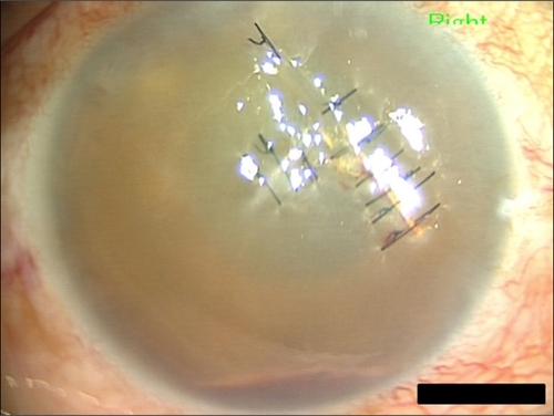 Figure 1 Photograph of anterior segment just prior to endoscopy-guided vitrectomy. Note severe corneal edema, hyphema, +++cells and fibrin exudates in anterior chamber, leading to tentative diagnosis of endophthalmitis with secondary glaucoma.