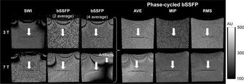 Figure 4 Comparison of SWI and bSSFP images of phantom witĥ1,000 labeled cells at 3 T (top row) and 7 T (bottom row).Notes: The original bSSFP images show banding artifacts which are suppressed in combined phase-cycled AVE, MIP, and RMS images. Severer banding artifact in bSSFP images with four averages is due to magnetic field drift with time. White arrows show the location of labeled cells.Abbreviations: AVE, average of the signal; bSSFP, balanced steady-state free precession; MIP, maximum intensity projection; RMS, root mean square; SWI, susceptibility-weighted imaging.