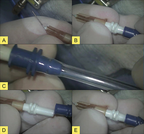 Figure 1 Illustration of instrument assembly before starting the surgery. (A) A 13 mm long 26G needle, with the bevel facing down. (B) The needle being connected to the double male Luer adapter. (C) Phacoemulsifier aspiration pathway. (D) Aspiration line being connected to the double male Luer adapter. (E) Completed instrument assembly.