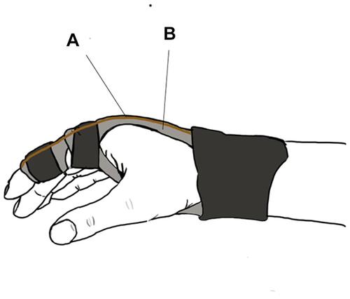 Figure 3 Orthosis of limit the radioulnar movement. (A) Elastic plastic material displayed in yellow. (B) Rigid material displays in gray and has a pully at MCP.