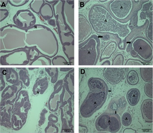 Figure 6 Histopathological changes in the prostate gland after treatment with (A and B) ZnOAE100(−) and (C and D) ZnOAE100(+) at a dose of 500 mg/kg for 90 days. Prostate gland sections were stained with hematoxylin and eosin. (A and C) Control for the prostate gland tubule. (B and D) 500 mg/kg treatment groups.aNote: aArrows in (B and D) show tubular hyperplasia in the prostate gland.Abbreviations: A, suppurative inflammation, N, normal tubule; ZnO, zinc oxide; ZnOAE100(−), 100 nm negatively charged ZnO; ZnOAE100(+), 100 nm positively charged ZnO.