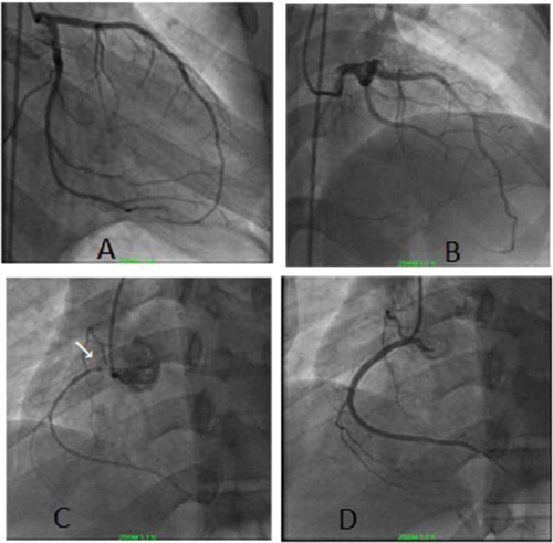 Figure 3. Left heart catheterization showing normal left coronary artery (A,B) and sub-total occlusion of right coronary artery with filling defect at proximal segment (white arrow) consistent with acute thrombus (C). The lesion was treated with balloon angioplasty and stenting with excellent results (D)