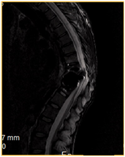 Figure 1. T2W MRI, sagittal view of the dorsal spine, of a 22-year-old male involved in a motor vehicle accident 2 years ago. He presented with fracture dislocation of D12–L1 vertebrae. The patient was paraplegic, ASIA A score. The follow-up MRI shows the failure of instrumentation resulting in severe kyphosis and obliteration of the spinal canal which is associated with spinal cord atrophy.