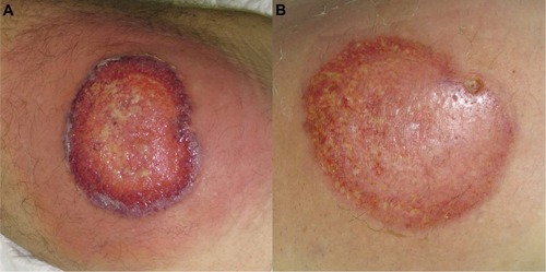 Figure 1 (A) Ulcerative stage of a pyoderma gangrenosum lesion, showing the typical violaceous, raised undermined border, with a granulation base, surrounded by a erythematous halo. (B) Healing stage, after 4 days therapy with systemic corticosteroids and cyclosporine, showing a decrease in the surrounding inflammation.