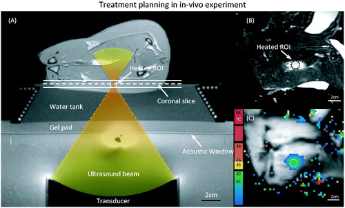 Figure 3. (A) T1-weighted image along the ultrasound beam axis shows the experimental set-up for performing hyperthermia in a rabbit model. A gel pad and a water tank were placed on top of the acoustic window of the clinical MR-HIFU system to elevate the animal to the location of the ultrasound focus. The conical water tank also maintained the body temperature of the animals. (B) T2-weighted image transverse to the beam axis (along the dashed line in A) shows the VX2 tumour and the location of heating. (C) The spatial temperature distribution measured midway during treatment shows localised heating within the target area, well maintained in the desired range of 41–43 °C.