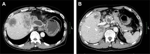 Figure 5 The tumor was larger after apatinib treatment was stopped, and a CT scan after 2 months suggested progressive disease (A and B, September 9, 2016).